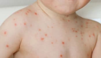 Gripe del tomate el nuevo virus que afecta a niños menores de 5 años detectado en la India