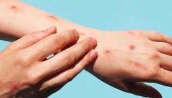 OMS y científicos piden acción urgente contra cepa de la viruela símica