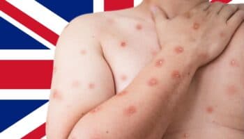 Reino Unido detecta primer caso de la nueva variante de mpox